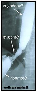 Barium swallow image showing a stomach stricture.
